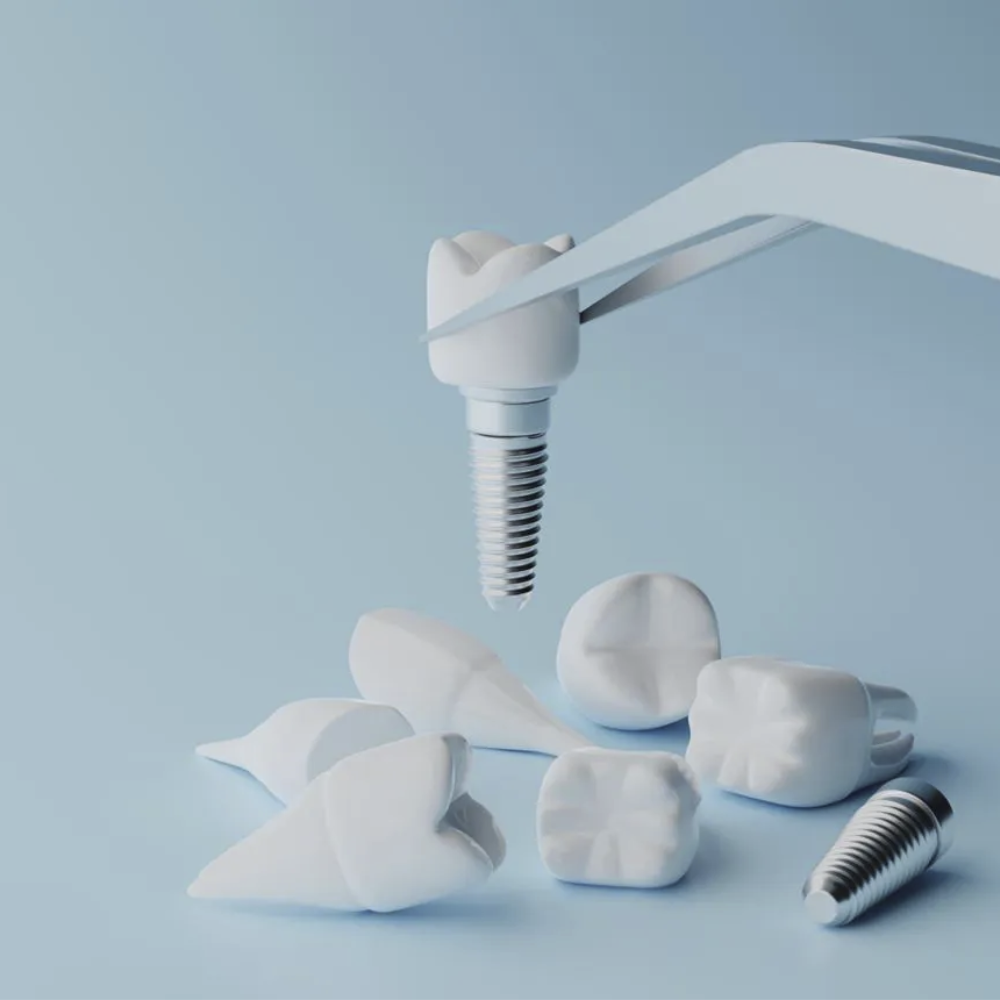 Recupera tu Sonrisa en un Día: Innovaciones en Implantología Dental