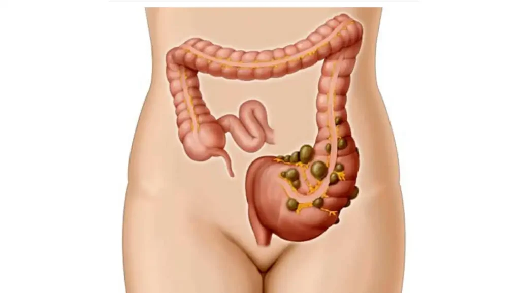 Divertículos en el Colon: Comprendiendo su Impacto y Manejo